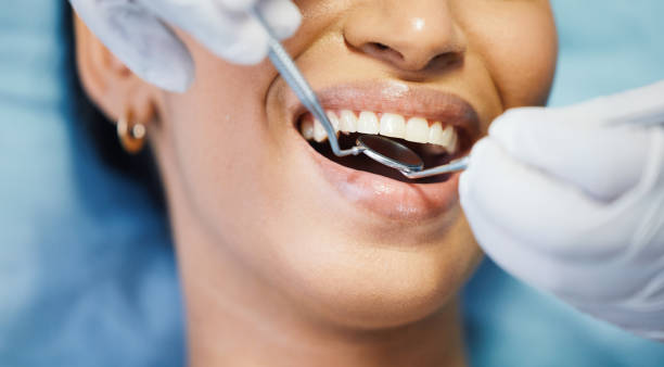 Best Knocked-Out Tooth (Avulsed Tooth) Treatment in Glencoe, AL